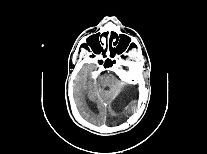 File:Brain injury by firearm projectile (Radiopaedia 82068-96088 B 99).jpg