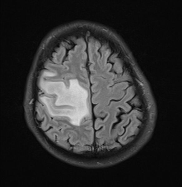 File:Brain metastases - lung cancer primary (Radiopaedia 75060-86115 Axial FLAIR 20).jpg