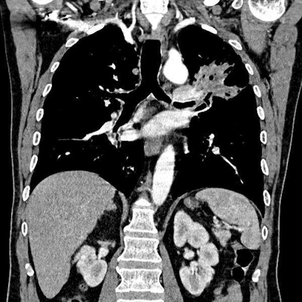File:Brain metastases - lung cancer primary (Radiopaedia 75060-86116 C+ arterial phase 39).jpg