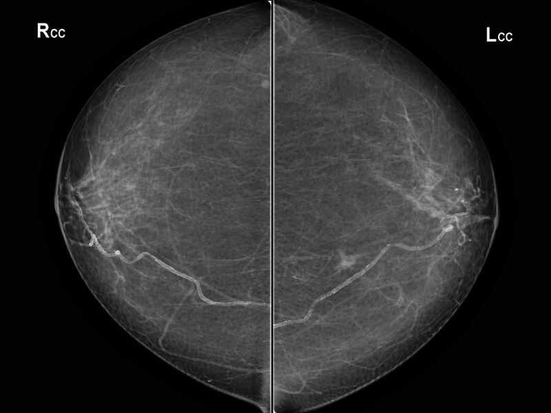 File:Breast cancer - spiculated mass occult on ultrasound (Radiopaedia 62220-70383 CC 1).jpeg
