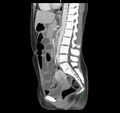 Broad ligament hernia (Radiopaedia 63260-71832 C 28).jpg