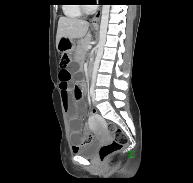 File:Broad ligament hernia (Radiopaedia 63260-71832 C 28).jpg