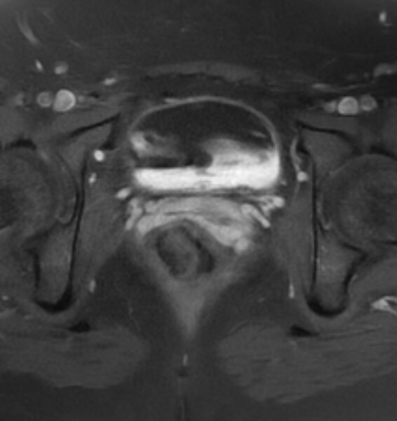 File:Broad ligament leiomyoma (Radiopaedia 81634-95516 Axial T1 C+ fat sat 21).jpg