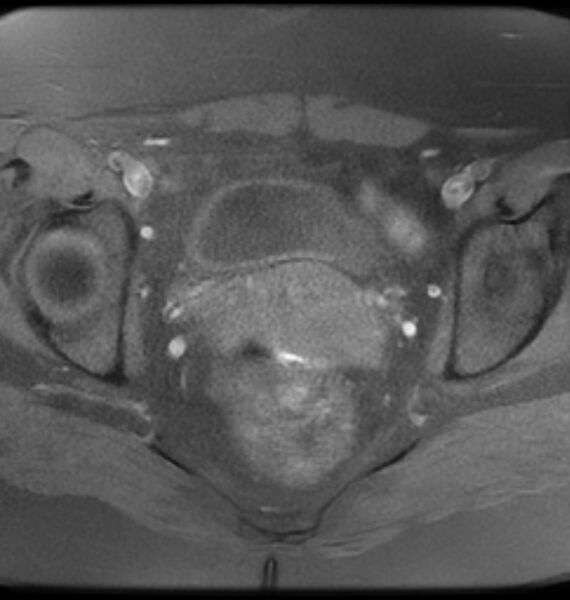 File:Broad ligament leiomyoma (Radiopaedia 81634-95516 Axial T1 fat sat 16).jpg