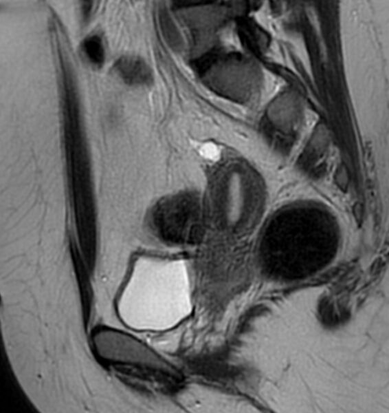 File:Broad ligament leiomyoma (Radiopaedia 81634-95516 Sagittal T2 18).jpg