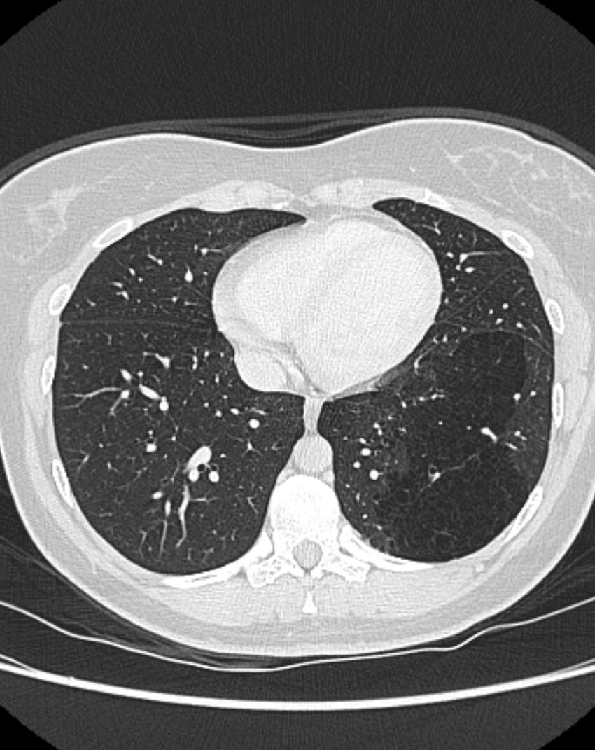 Bronchial atresia (Radiopaedia 50007-55297 Axial lung window 76).jpg