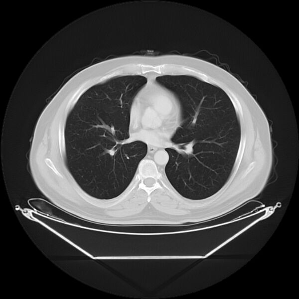 File:Bronchogenic carcinoma with upper lobe collapse (Radiopaedia 29297-29726 Axial lung window 19).jpg