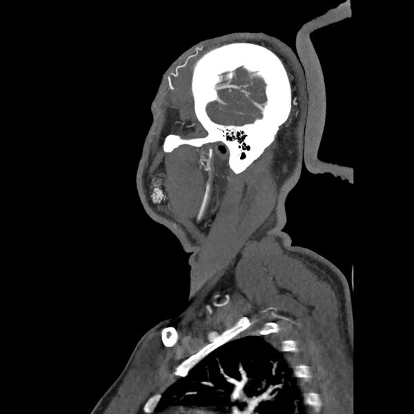 File:Buccal fat pad arteriovenous malformation (Radiopaedia 70936-81144 C 26).jpg