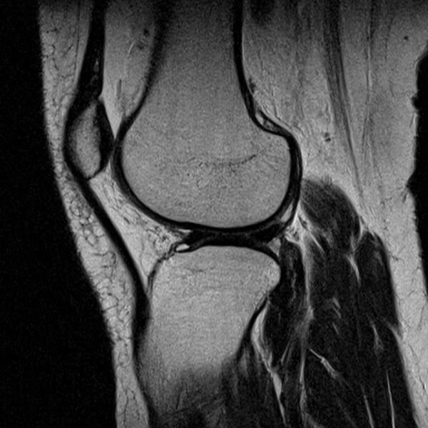 File:Bucket handle tear - medial meniscus (Radiopaedia 79028-91942 Sagittal T2 7).jpg