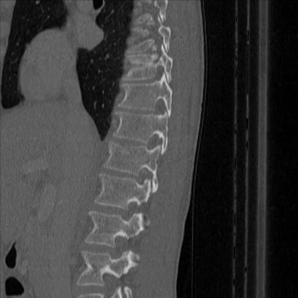 File:Bulging of paraspinal line in traumatic thoracal spinal compression fracture (Radiopaedia 29221-35872 Sagittal bone window 11).jpg