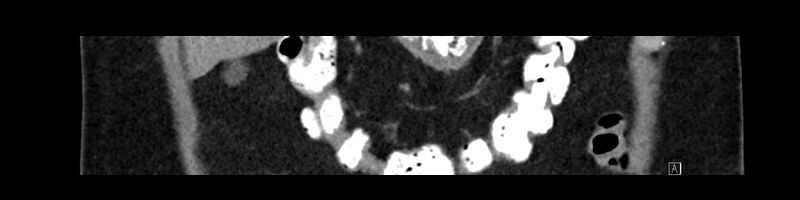 File:Buried bumper syndrome - gastrostomy tube (Radiopaedia 63843-72575 Coronal Inject 29).jpg