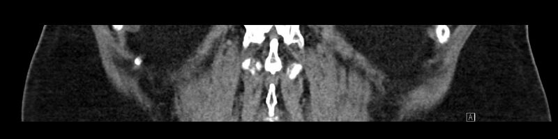 File:Buried bumper syndrome - gastrostomy tube (Radiopaedia 63843-72575 Coronal Inject 84).jpg