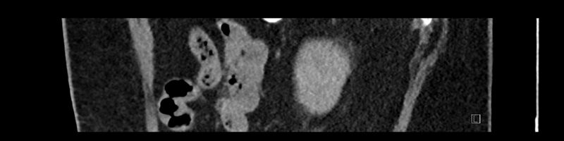 File:Buried bumper syndrome - gastrostomy tube (Radiopaedia 63843-72575 Sagittal Inject 24).jpg
