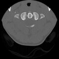 C5 facet fracture (Radiopaedia 58374-65499 Axial bone window 18).jpg