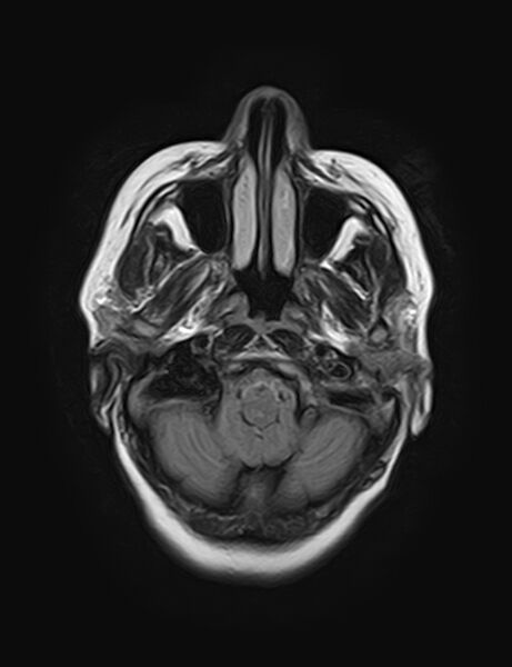 File:Calcified cerebral hydatid cyst (Radiopaedia 65603-74699 Axial FLAIR 3).jpg