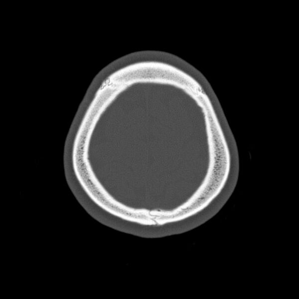 File:Calvarial osteoma (Radiopaedia 36520-38079 Axial bone window 94).jpg