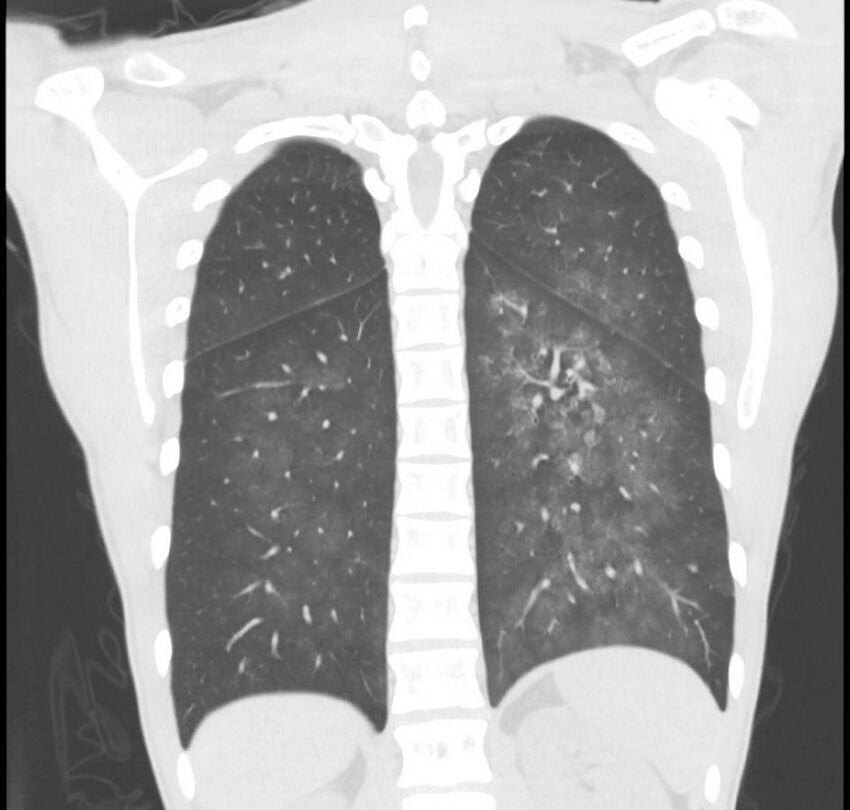 Cannabis-induced diffuse alveolar hemorrhage (Radiopaedia 89834-106946 Coronal lung window 23).jpg