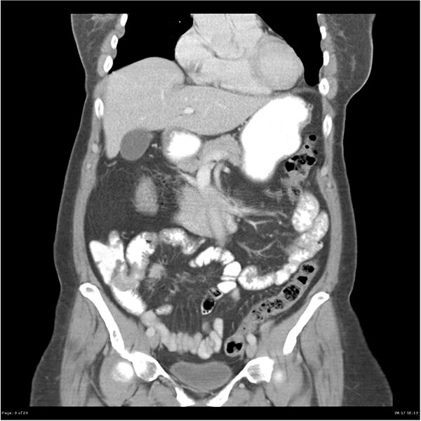 File:Carcinoid tumor of the ileum with metastasis to orbit (Radiopaedia 28165-28425 B 9).jpg