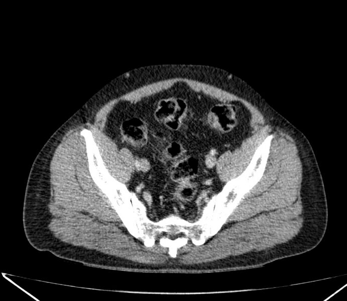 File:Carcinoid tumor with hepatic metastases (Radiopaedia 22651-22670 C 68).jpg