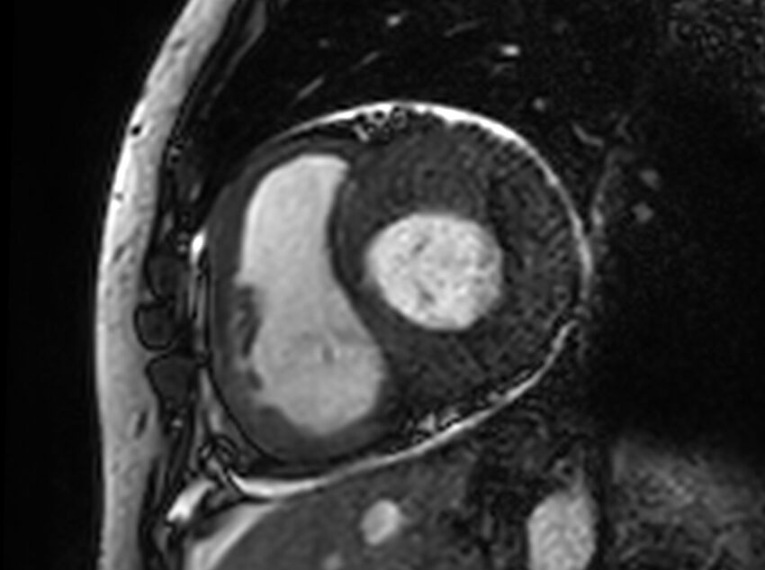 Cardiac amyloidosis (Radiopaedia 61600-69579 Short axis bSSFP 256).jpg