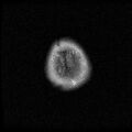 Caroticocavernous fistula (Radiopaedia 8617-9440 Axial FLAIR 22).jpg