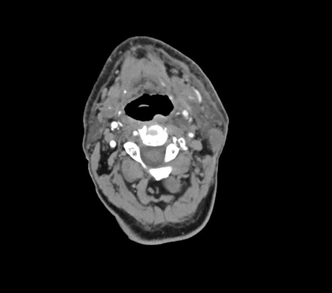 File:Carotid artery pseudoaneurysm - left (Radiopaedia 84030-99259 Axial 69).jpg