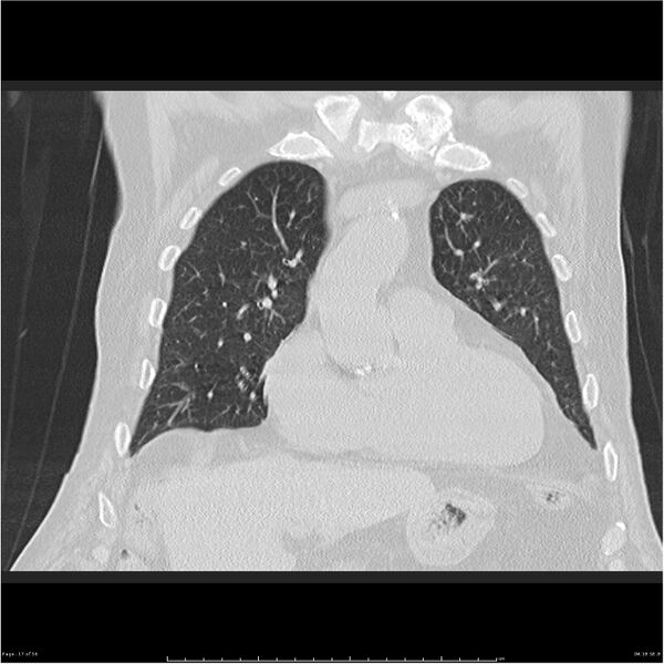File:Cavitating left lower lobe lesion - squamous cell lung cancer (Radiopaedia 27749-28176 Coronal lung window 17).jpg