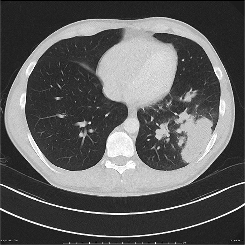 Cavitating lung cancer (Radiopaedia 25796-25945 Axial lung window 42).jpg