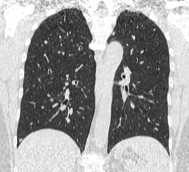 File:Cavitating pulmonary metastases (Radiopaedia 17796-17555 Coronal lung window 17).jpg