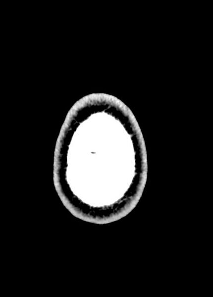 File:Cavum septum pellucidum and cavum vergae (Radiopaedia 77797-90060 Axial Brain Window 104).jpg