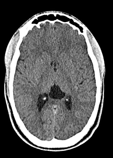 File:Cavum septum pellucidum and cavum vergae (Radiopaedia 77797-90060 Axial Brain Window 53).jpg