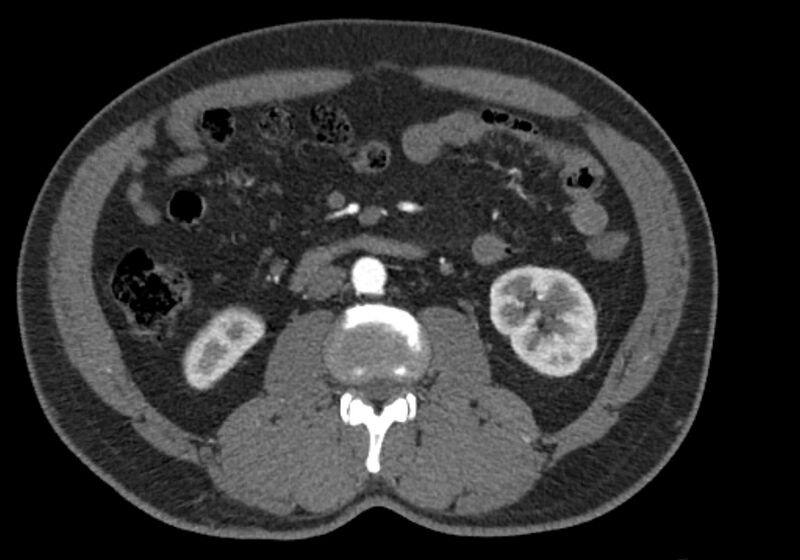 File:Celiac artery dissection (Radiopaedia 52194-58080 A 53).jpg