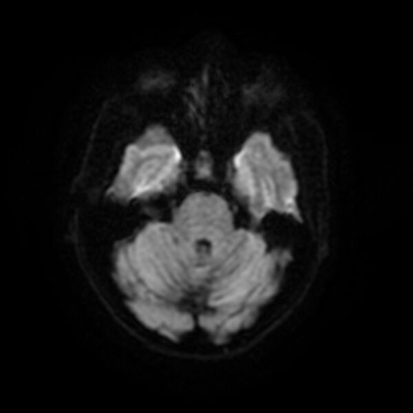 File:Central neurocytoma (Radiopaedia 67618-77021 Axial DWI 6).jpg