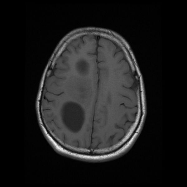 File:Central neurocytoma (Radiopaedia 67618-77021 Axial T1 19).jpg