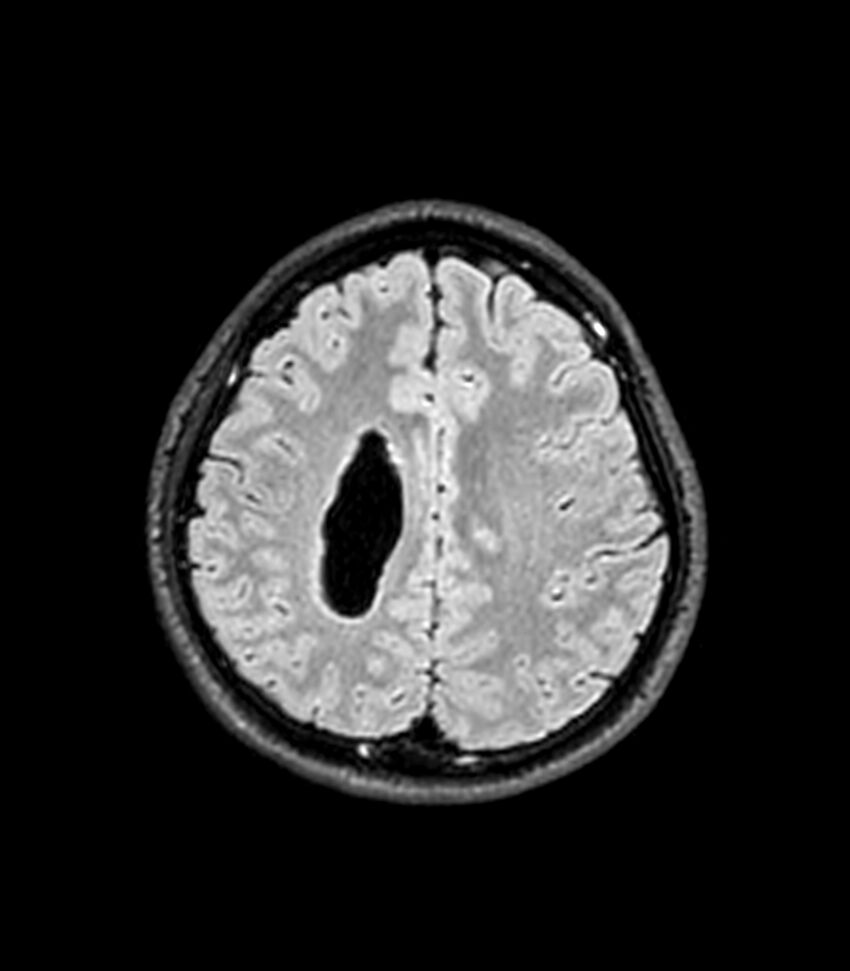 Central neurocytoma (Radiopaedia 79320-92380 Axial FLAIR 97).jpg