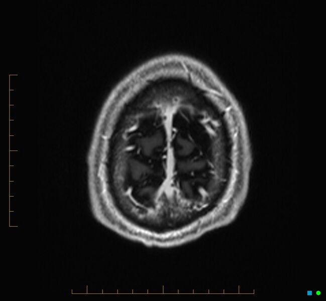 File:Cerebellar gangliocytoma (Radiopaedia 65377-74422 Axial T1 C+ 135).jpg