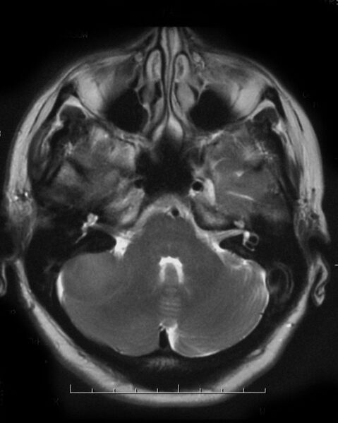 File:Cerebellopontine angle meningioma (Radiopaedia 2597-6293 Axial T2 1).jpg