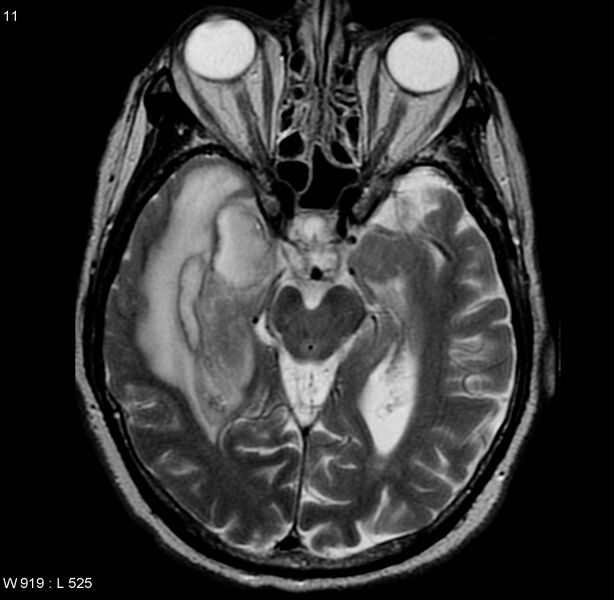 File:Cerebral abscess and ventriculitis (Radiopaedia 5024-6885 Axial T2 1).jpg