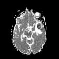 Cerebral abscess post cardiac surgery (Radiopaedia 27244-27420 Axial ADC 10).jpg