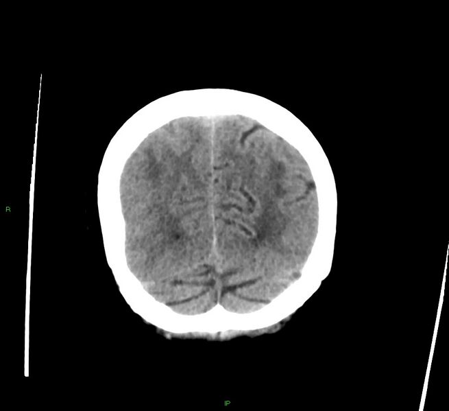 File:Cerebral amyloid angiopathy-associated lobar intracerebral hemorrhage (Radiopaedia 58378-65516 Coronal non-contrast 13).jpg