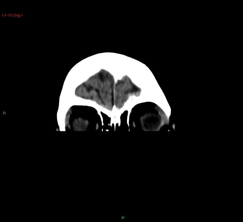 Cerebral amyloid angiopathy-associated lobar intracerebral hemorrhage (Radiopaedia 58378-65518 Coronal non-contrast 63).jpg