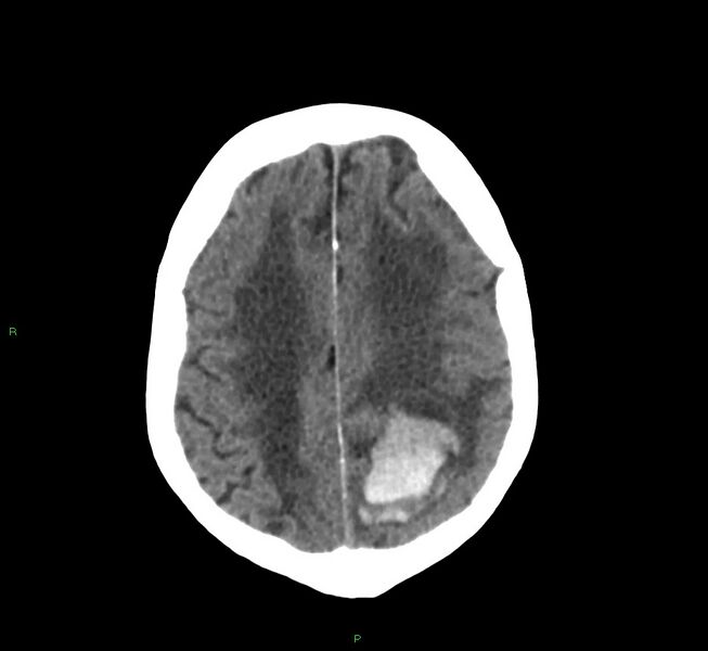 File:Cerebral amyloid angiopathy-associated lobar intracerebral hemorrhage (Radiopaedia 58530-65688 Axial non-contrast 13).jpg