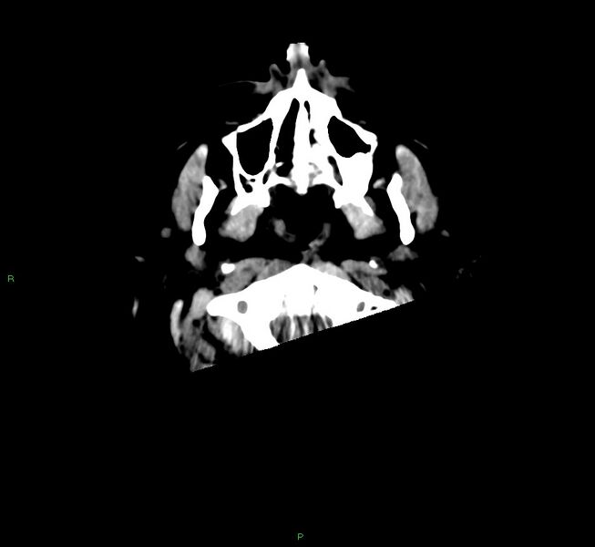 File:Cerebral amyloid angiopathy-associated lobar intracerebral hemorrhage (Radiopaedia 58560-65723 Axial non-contrast 53).jpg
