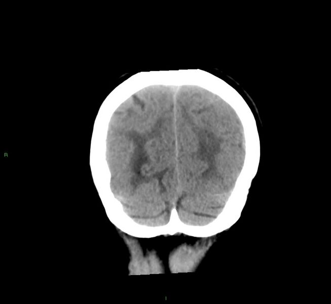 File:Cerebral amyloid angiopathy-associated lobar intracerebral hemorrhage (Radiopaedia 58561-65724 Coronal non-contrast 14).jpg