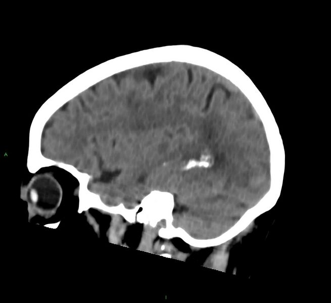 File:Cerebral amyloid angiopathy-associated lobar intracerebral hemorrhage (Radiopaedia 58757-65978 C 38).jpg