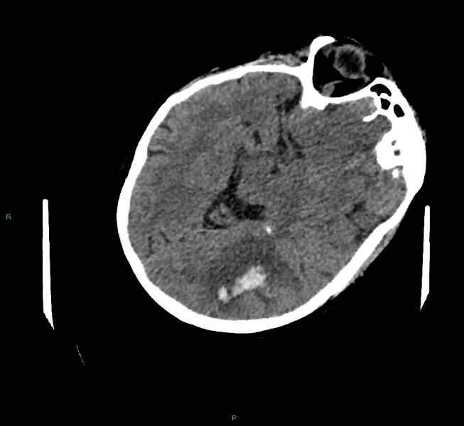 File:Cerebral amyloid angiopathy-associated lobar intracerebral hemorrhage (Radiopaedia 58757-65979 Axial non-contrast 43).jpg