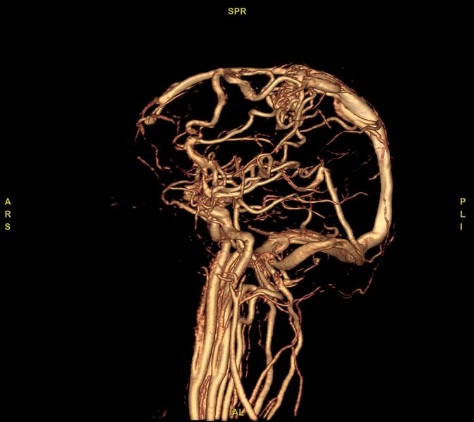 File:Cerebral arteriovenous malformation (Radiopaedia 61964-70029 VRT 51).jpg