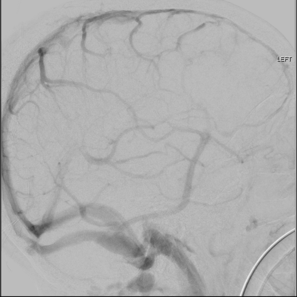 File:Cerebral arteriovenous malformation with lobar hemorrhage (Radiopaedia 44725-48513 LT CCA IC 44).png