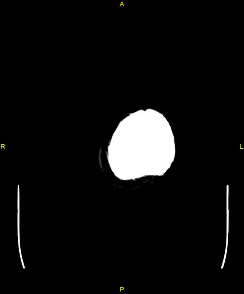 File:Cerebral autosomal dominant arteriopathy with subcortical infarcts and leukoencephalopathy (CADASIL) (Radiopaedia 86108-102051 Axial non-contrast 116).jpg