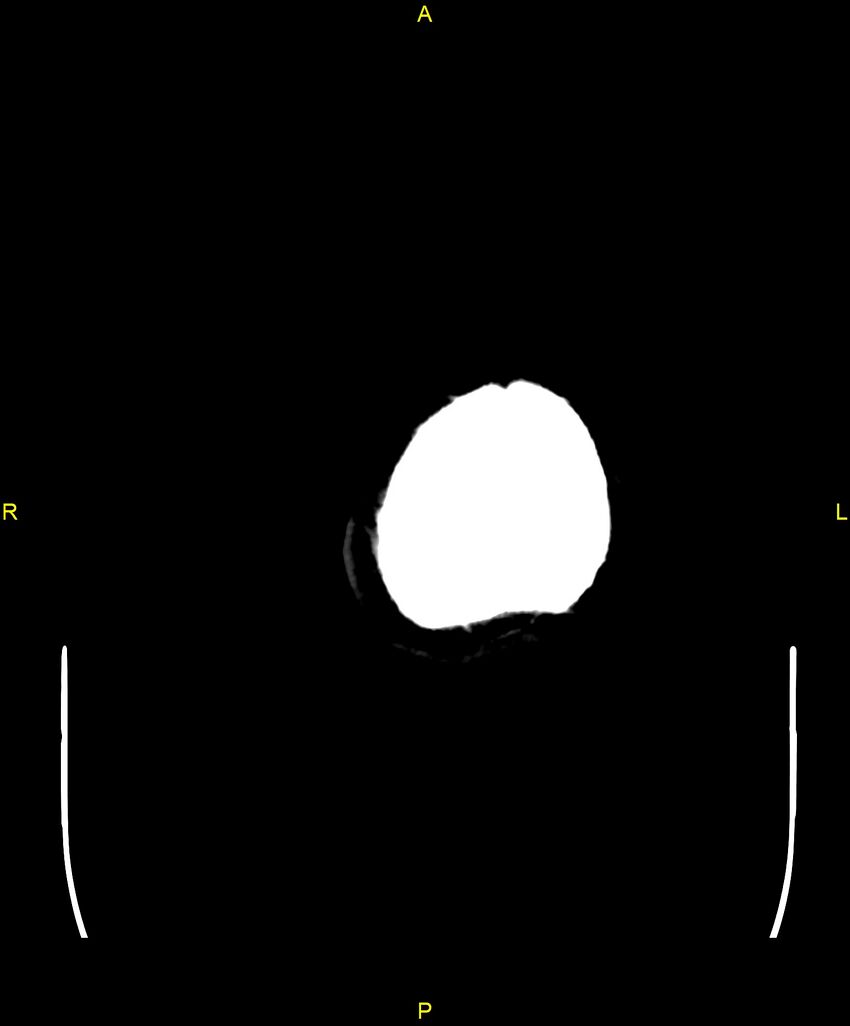 Cerebral autosomal dominant arteriopathy with subcortical infarcts and leukoencephalopathy (CADASIL) (Radiopaedia 86108-102051 Axial non-contrast 116).jpg